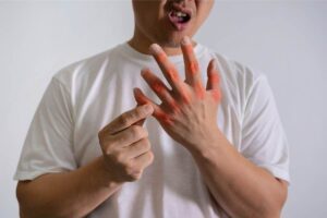 High Uric Acid